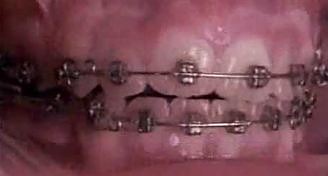 Wynik leczenia ortodontycznego - 18 miesięcy w kilkanaście sekund